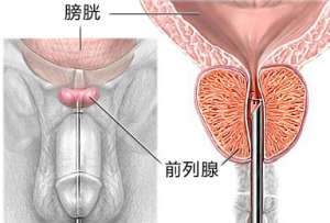 男性需警惕 慢性前列腺炎一些症状